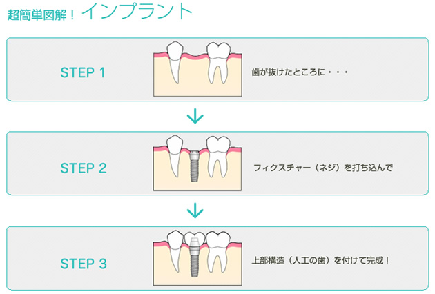 超簡単図解！インプラント