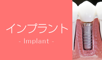 インプラント　- Implant -